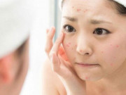 Công nghệ Nano Neem "đánh bay" nỗi lo mụn trứng cá