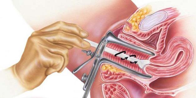 Dấu hiệu cảnh báo ung thư cổ tử cung cần đi khám ngay - 2