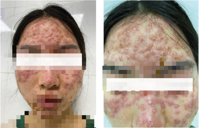 Cô gái trẻ cấp cứu vì nhiễm trùng nặng sau khi detox trị mụn, bác sĩ cảnh báo tình trạng hoại tử, thậm chí mất mạng vì lý do này - 1
