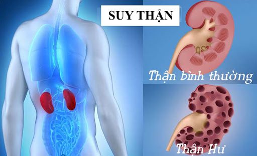 Dấu hiệu nhận biết bệnh suy thận bạn cần biết - 1