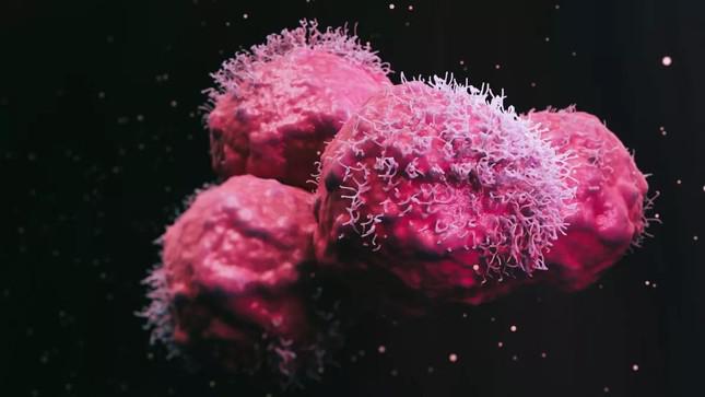 Người phụ nữ được chẩn đoán mắc 12 khối u có đột biến gien chưa từng thấy ở người - 1