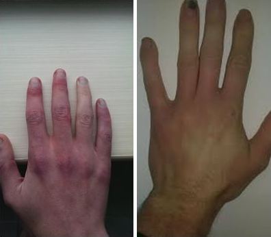 Người đàn ông 38 tuổi có bàn tay chuyển sang màu xanh, đỏ mỗi khi tức giận - 1