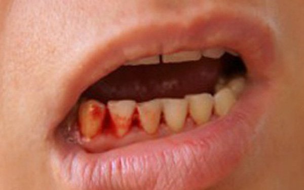 Tử vong do sốt xuất huyết: Có trường hợp mới 13 tuổi