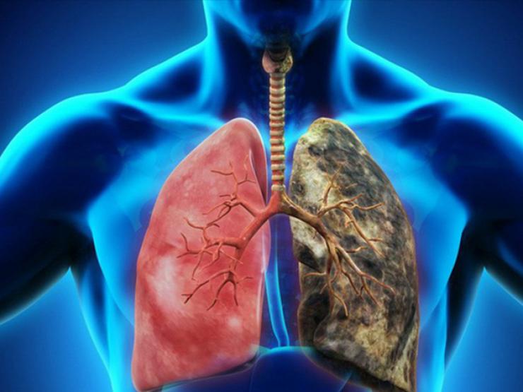 Những hiểu lầm thường gặp về bệnh ung thư phổi