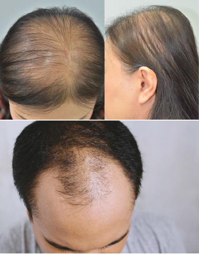 Rụng tóc nhiều chữa mãi không khỏi, nguy cơ hói phải làm sao? - 1