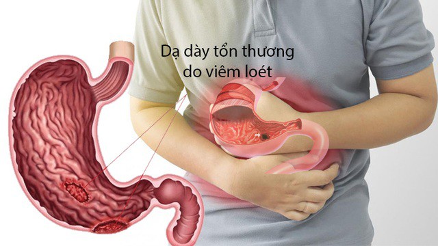 Ai bị đau dạ dày cần biết điều này, 5 thực phẩm nên ăn để phòng các cơn đau tái phát - 1