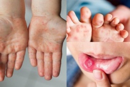 Đừng chủ quan với những biến chứng nguy hiểm của bệnh tay chân miệng!