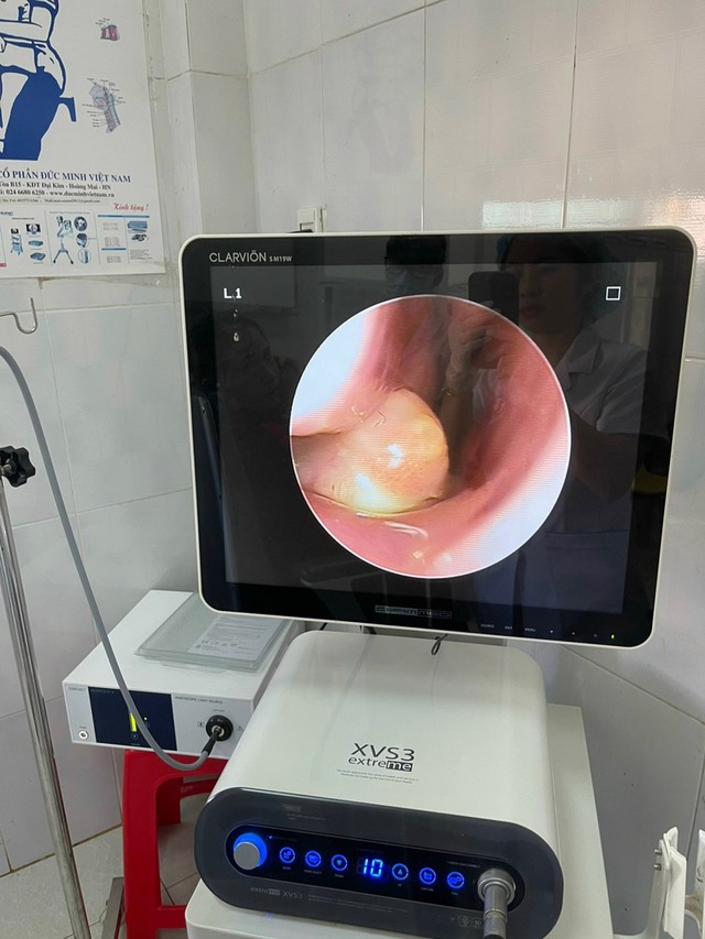 Hi hữu: Trẻ 4 tuổi mọc răng trong khoang mũi - 1