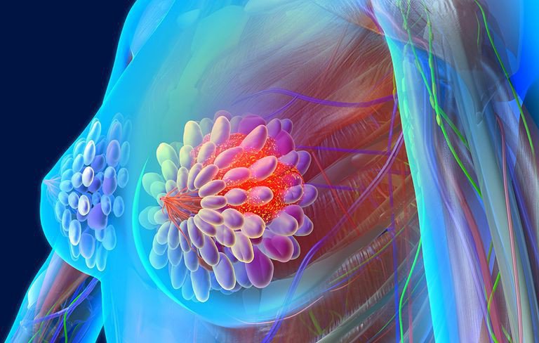 Bị ung thư vú nhưng chữa thuốc nam, người phụ nữ xuất hiện khối u to như quả bưởi - 2