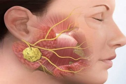 Dấu hiệu nhận biết sớm ung thư vòm họng